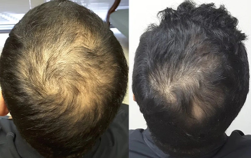 Before and 1 year after using Minoxidil to treat male pattern baldness