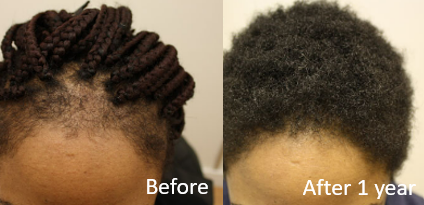 2% topical Minoxidil for traction alopecia