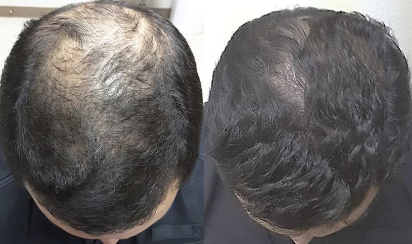 Before and after results of using 5% Minoxidil to treat hair loss