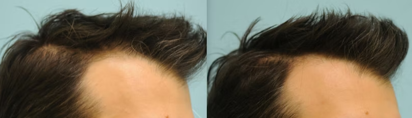 Minoxidil for crown hair loss