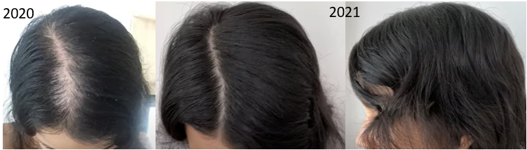 Minoxidil for female pattern hair loss