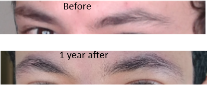 Before and after taking Minoxidil for eyebrow hair