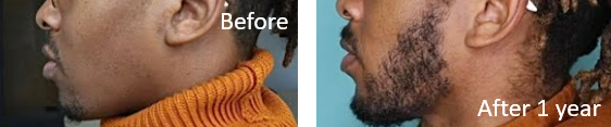 Before and after Minoxidil treatment for beard hair