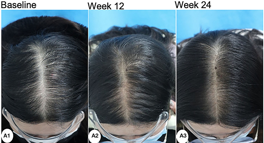 Minoxidil results for female pattern hair loss at 12 and 24 weeks