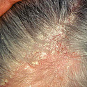 Seborrheic Dermatitis According To The NHS: Causes & Treatments