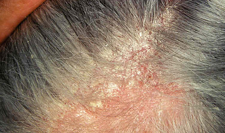 NHS Seborrheic Dermatitis Featured Image