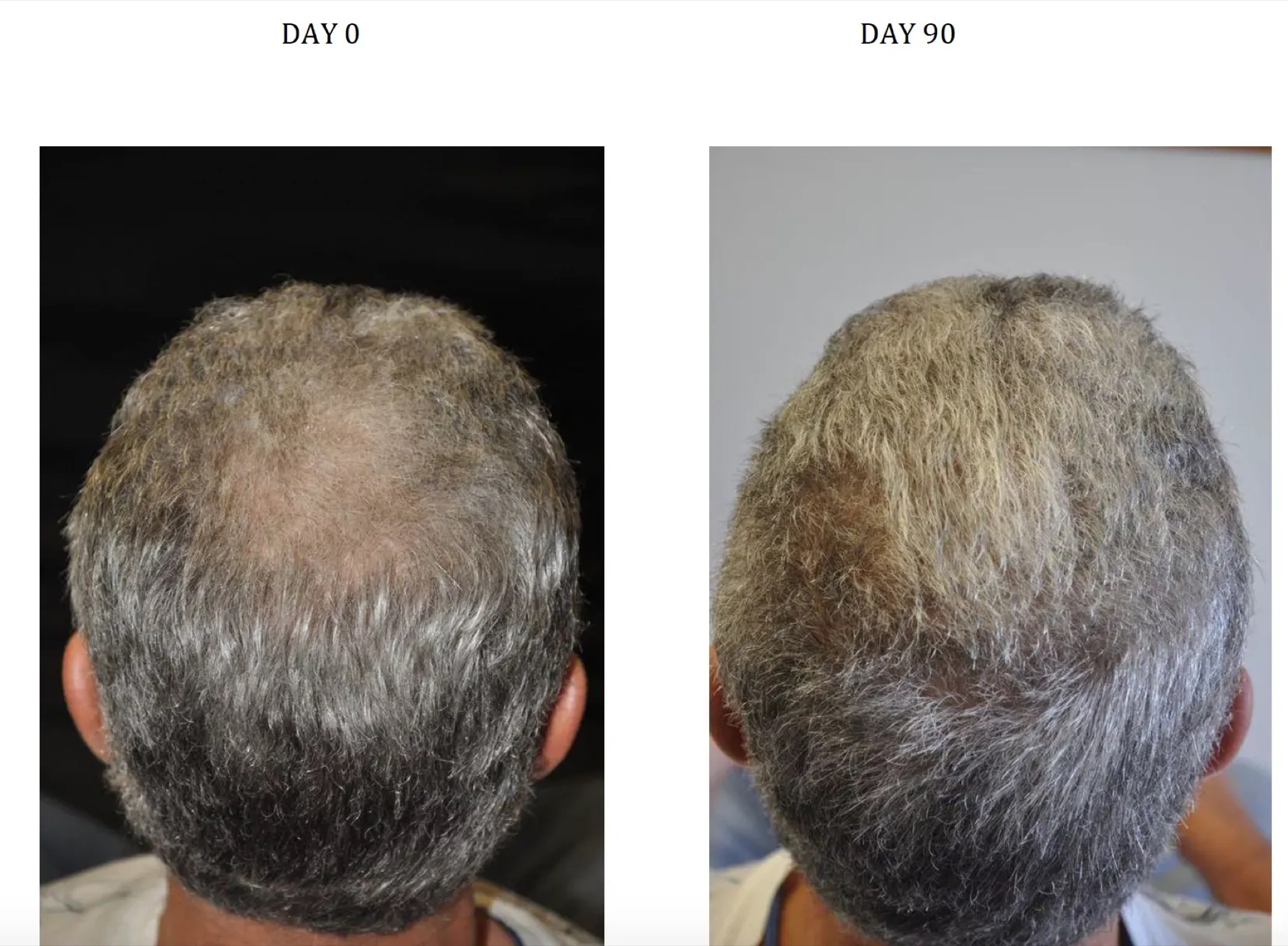 Results from taking Nanoxidil for 90 days