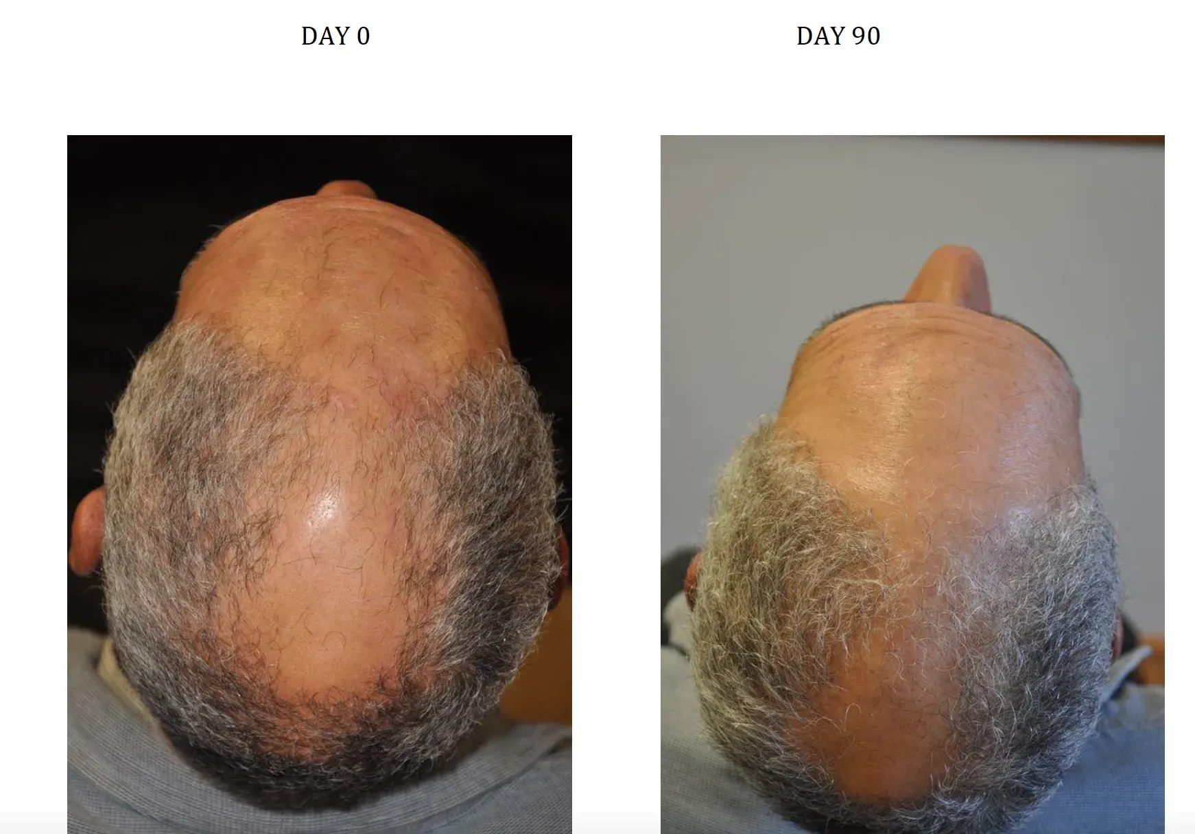 Before and after photos of taking Nanoxidil in a male patient