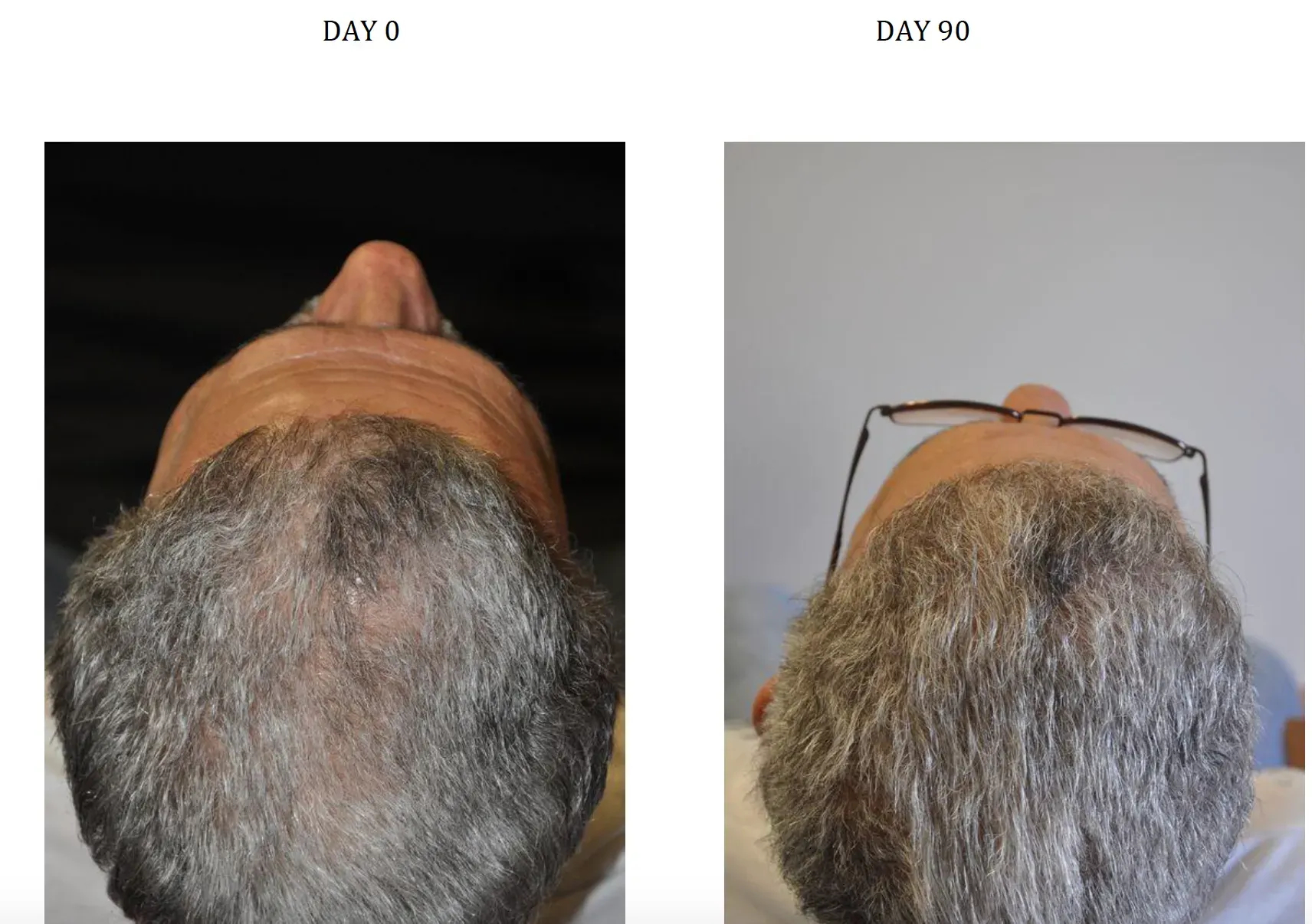 Before and after photos of hair growth by taking Nanoxidil