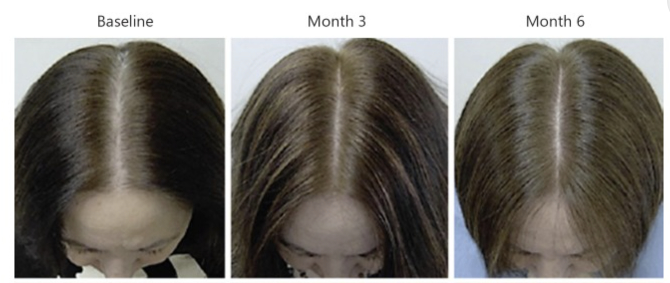 hair growth results in a female patient who took Nanoxidil