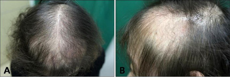 Native hair shedding in the recipient area of a female hair transplant patient
