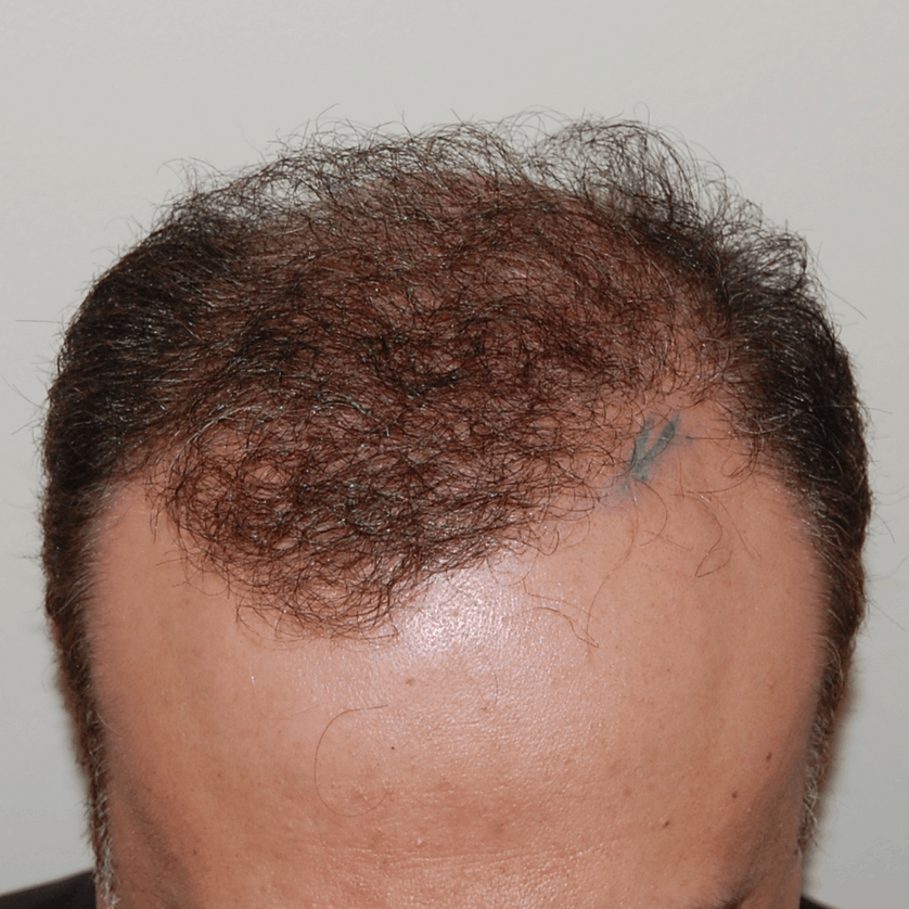 Norwood Stage 6 Photos, Treatments, Results Wimpole Clinic