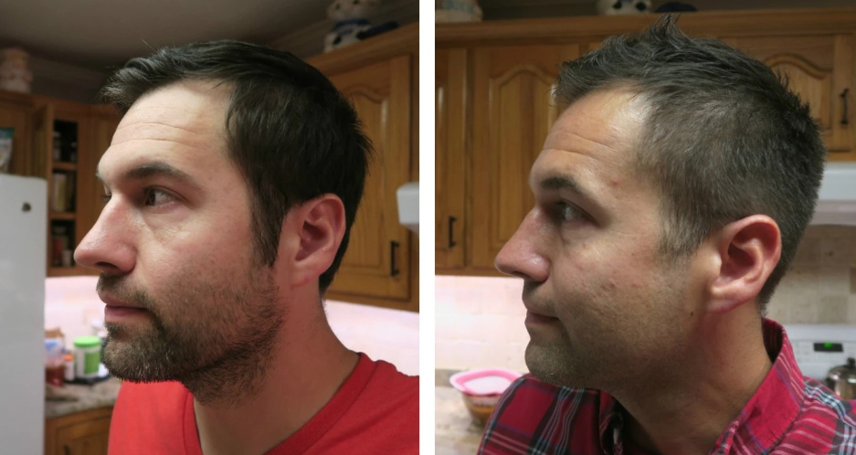Nick Shell before and after using rosemary oil for hair loss reduction