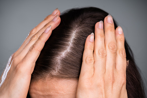 Perimenopause Hair Loss: Symptoms, Prevention, and Treatment, Wimpole Clinic