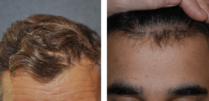 Norwood 2 stage of hair loss where the hairline recedes due to pattern hair loss