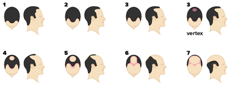 Norwood Scale used to diagnose hair loss in people with male pattern baldness