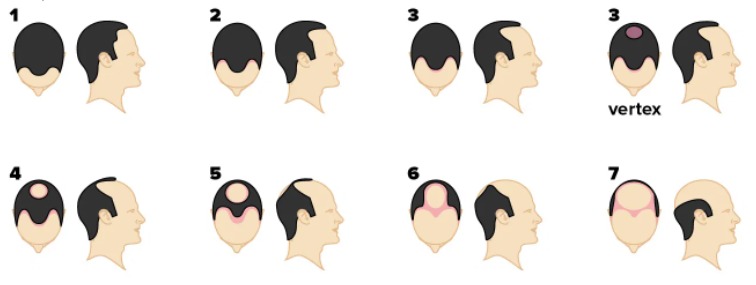 The Norwood Scale used to determine the level of hair loss in individuals who suffer from male pattern baldness