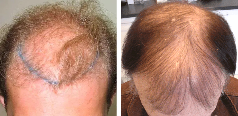 Norwood stage 6 hair loss