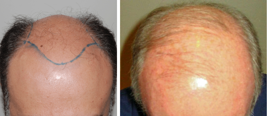 Norwood stage 7 hair loss