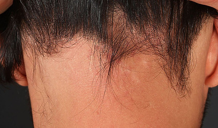 Ophiasis Alopecia Featured Image