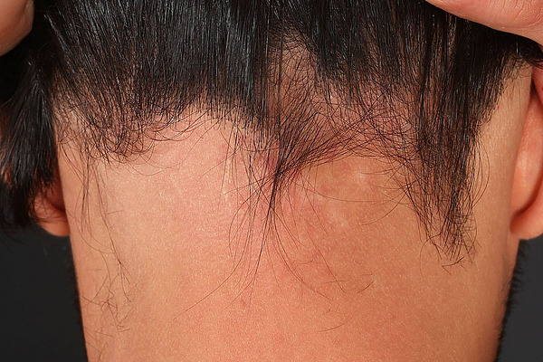Ophiasis Alopecia Featured Image