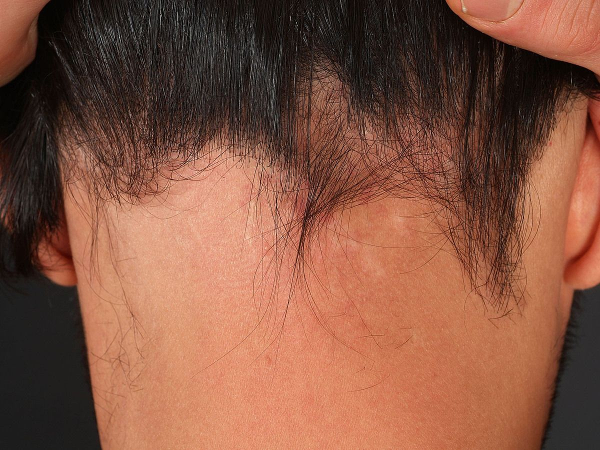 Ophiasis Alopecia featured image
