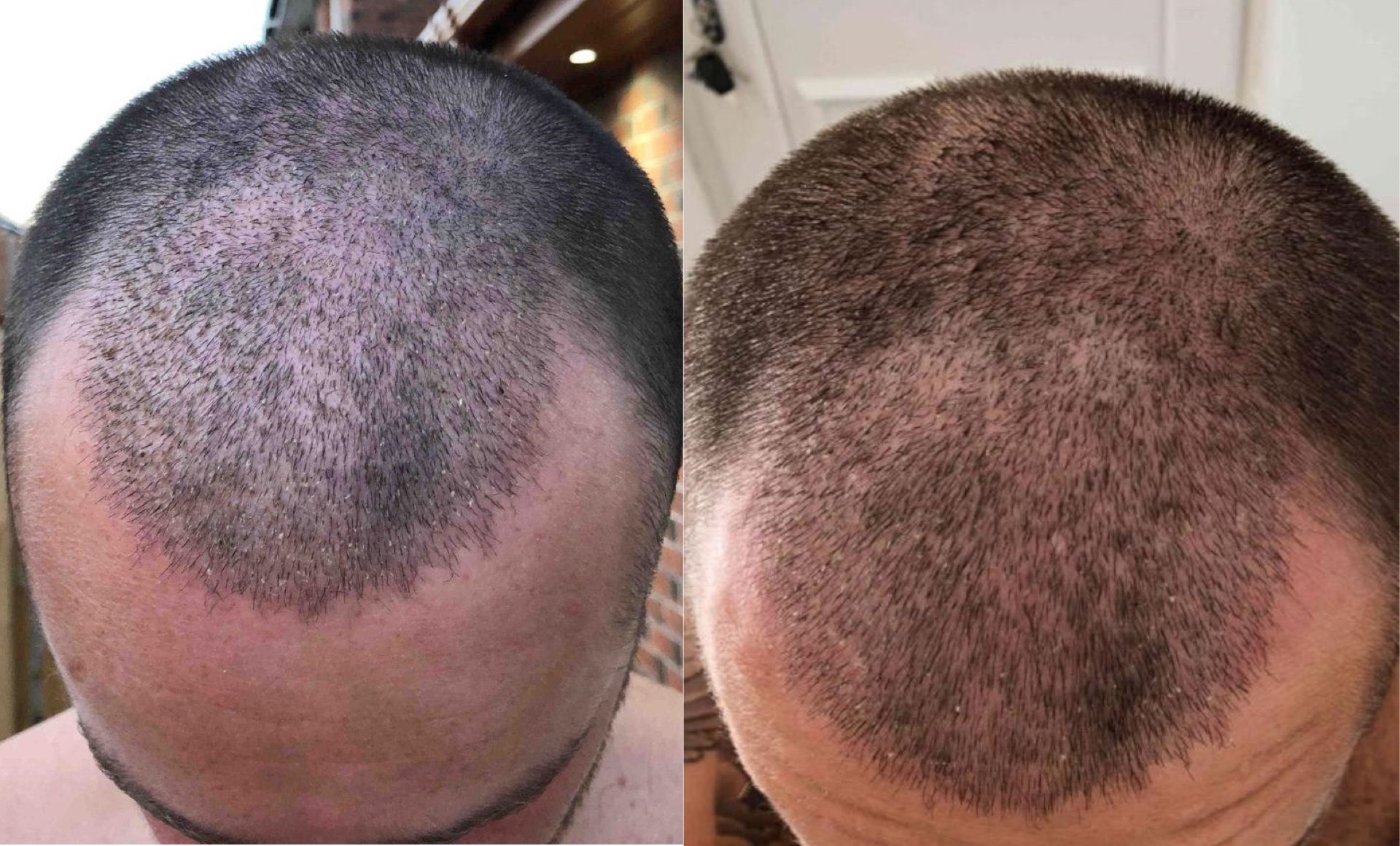 hair transplant 13 days (left) and 15 days (right) post-hair transplant