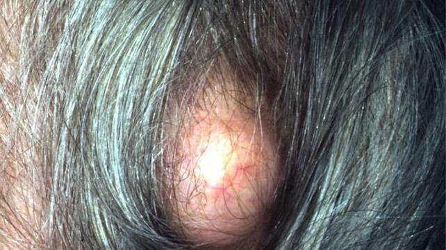 Pilar cyst on the scalp