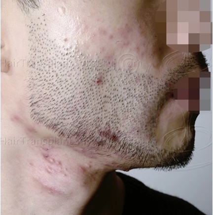 poor hair growth from failed beard hair transplant