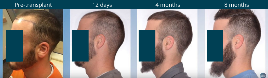 Post-hair transplant timeline of growth