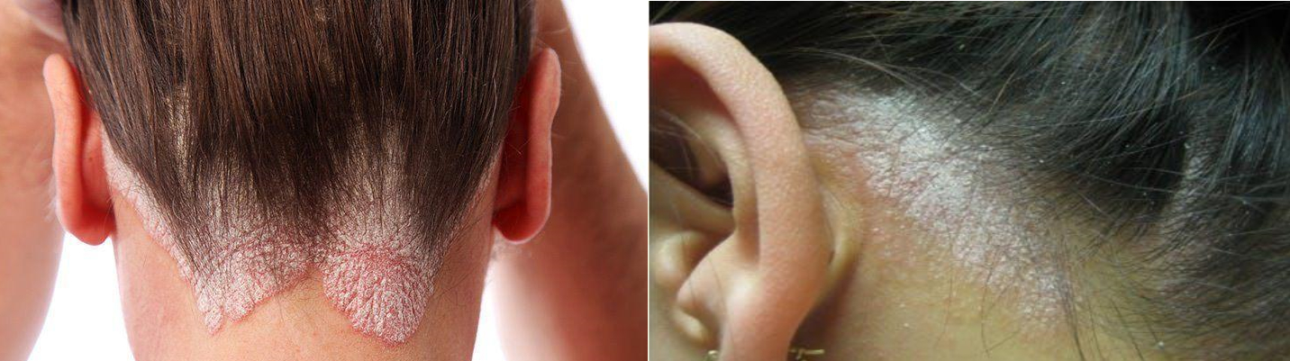 Psoriasis affecting scalp at the top of the neck (left), psoriasis affecting scalp behind the ears (right)
