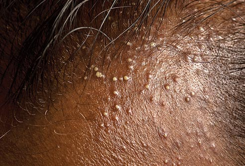 Traction Alopecia: When Is It Too Late?, Wimpole Clinic