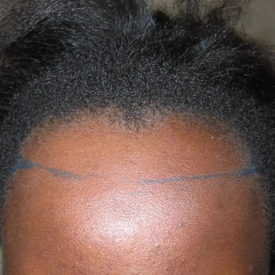 Patient with a V-shaped hairline