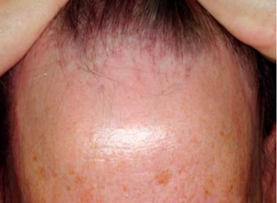 Example of a female receding hairline