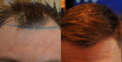 Patient before and after hair transplantation for a receding hairline