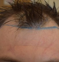 Another example of a receding hairline before hair transplantation