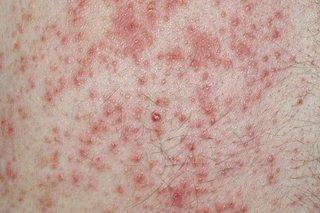 Red contact dermatitis rash