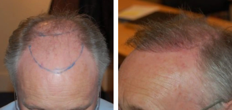 Results 3 months after a FUE hair transplant procedure