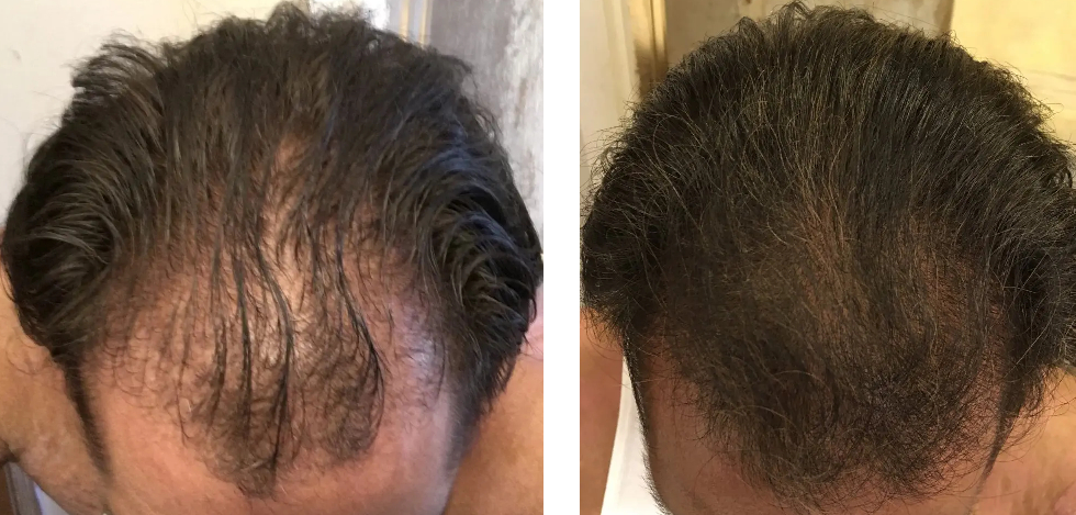 Finasteride Results: Timeline, Photos, Before &#038; After, Wimpole Clinic