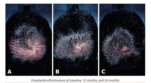 Can You Take Saw Palmetto With Finasteride Saw Palmetto vs Finasteride: How Effective Are They for Hair Loss