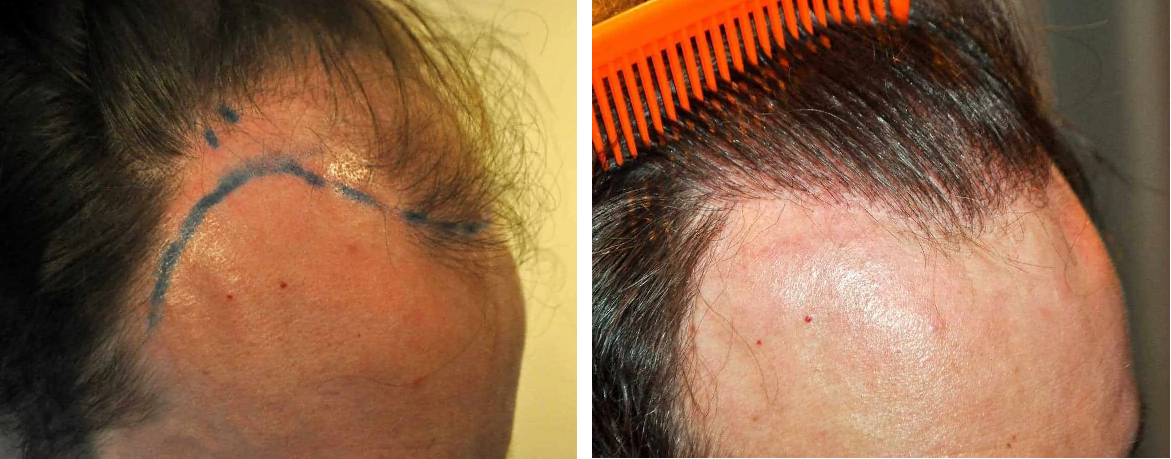 2000 Grafts Hair Transplant: Coverage, Results, Costs, Wimpole Clinic