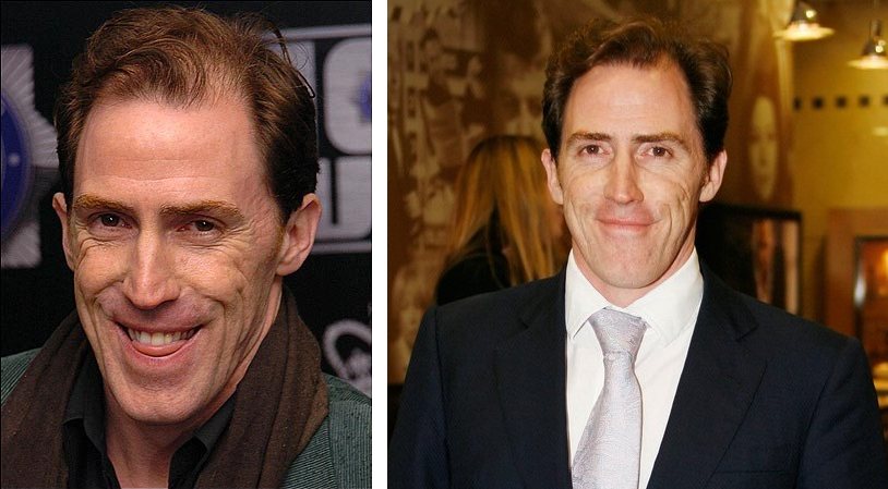 Rob Brydon before and after hair transplant