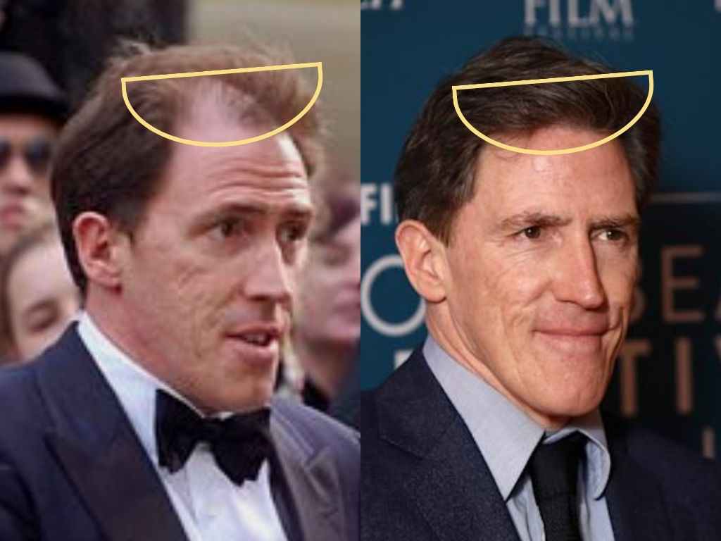 Rob Brydon before and after thicker hairline