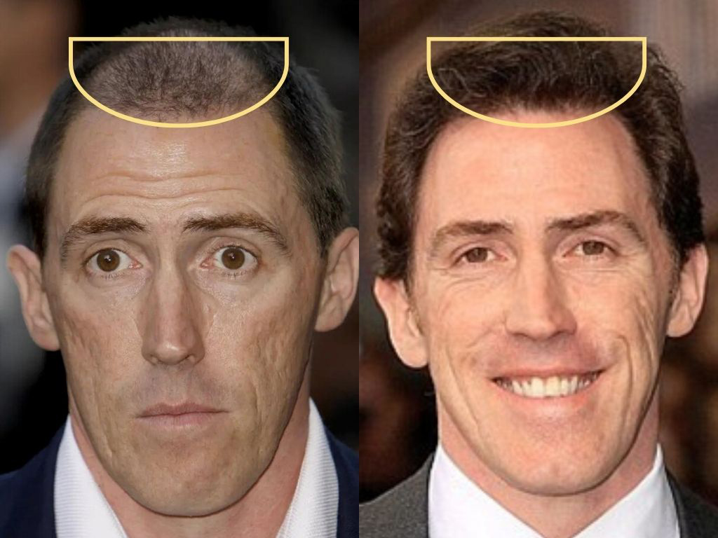 Rob Brydon with sparser hairline vs Rob Brydon with a thicker hairline