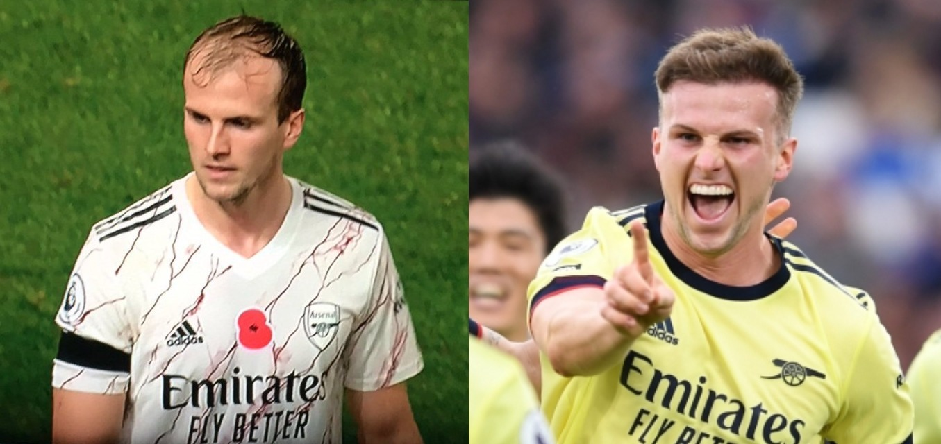 Rob Holding before and after hair transplant