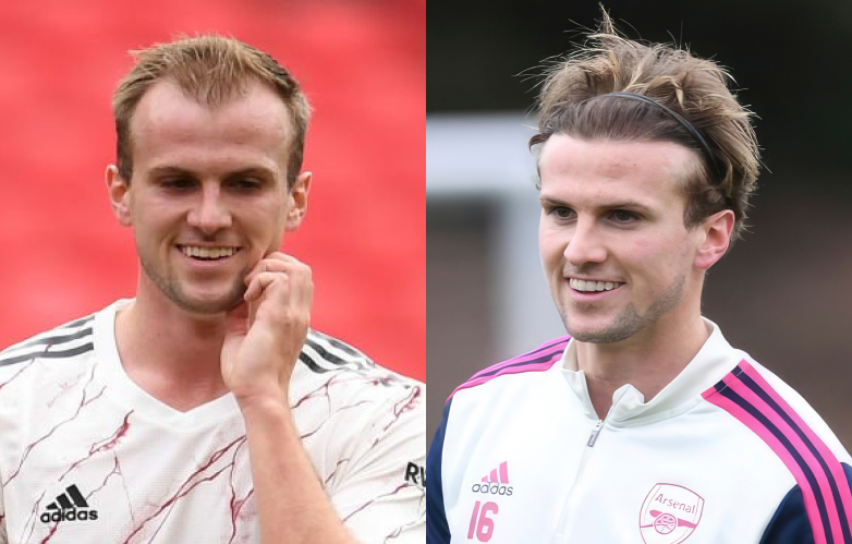 Rob Holding before and 20 months after hair transplant