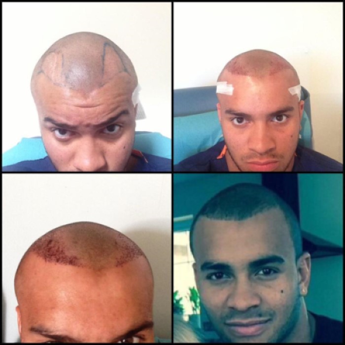 Jonathan Joseph's hair transplant