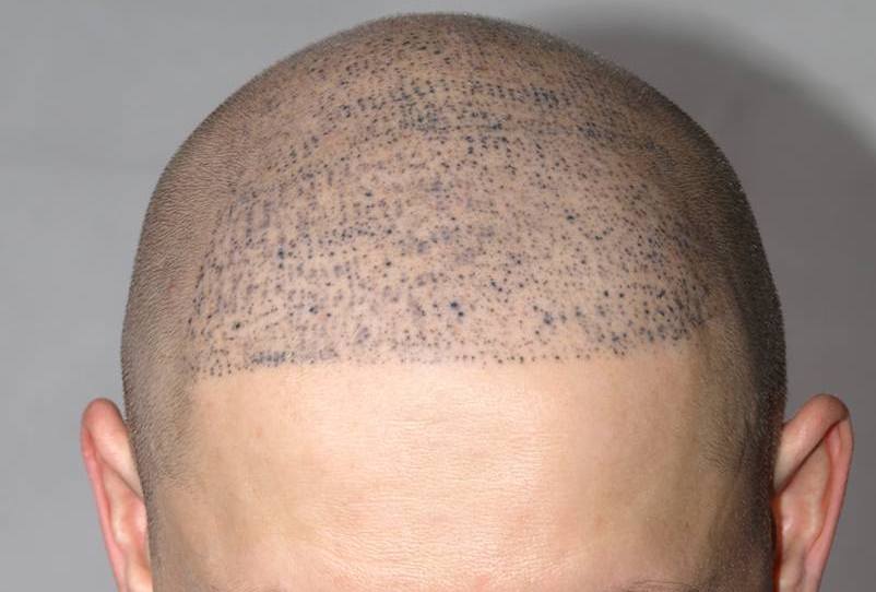 Example of scalp micropigmentation treatment gone wrong where the pigmentation dot pattern looks unnatural