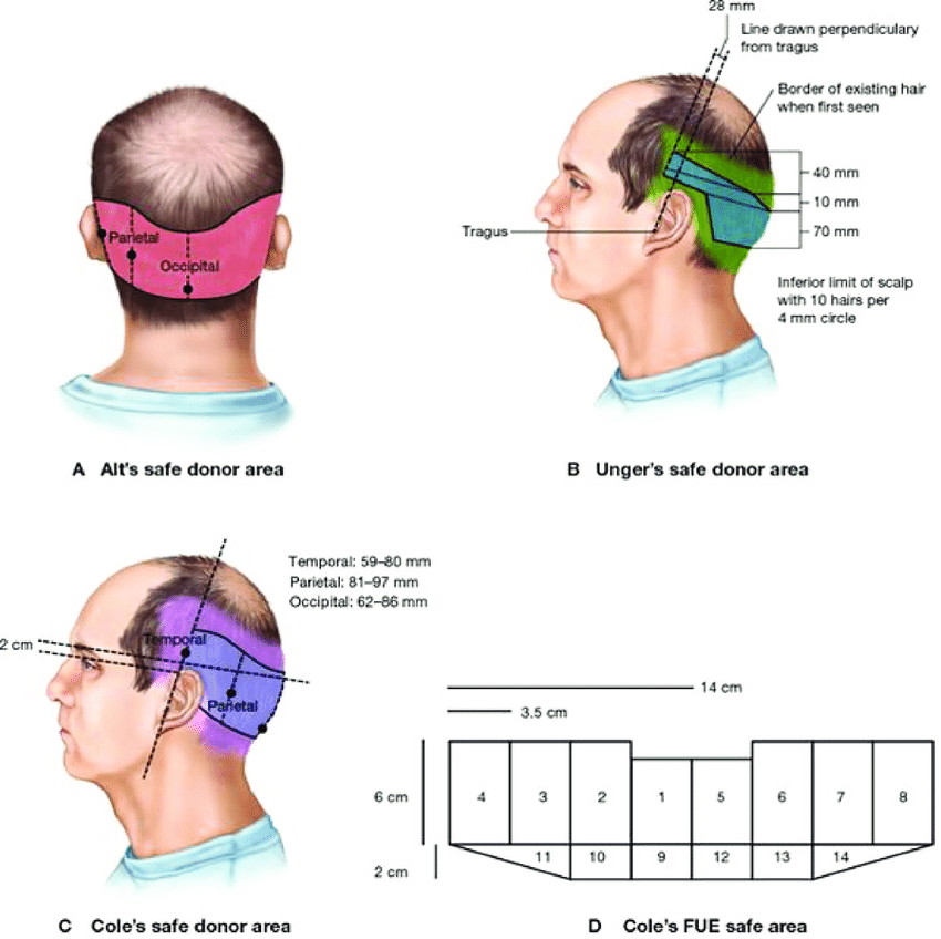 Informational graphic showing how the safe donor area is chosen for hair transplant procedures