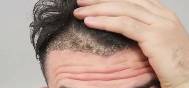 Scabs 14 days after hair transplant surgery